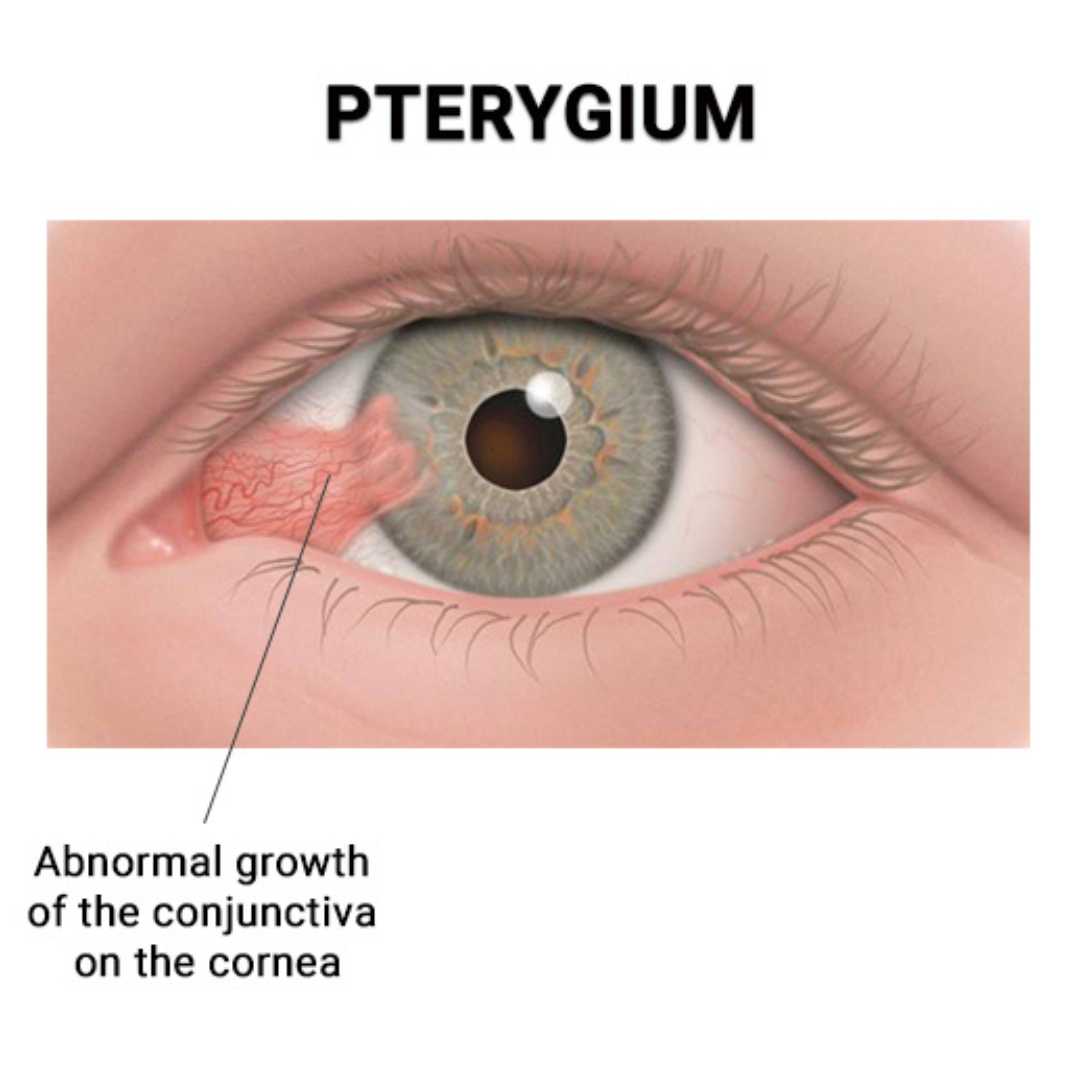 pterygium surgery cost