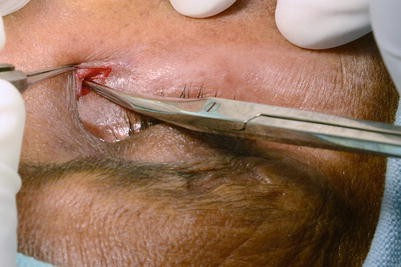 Dacryocystectomy eye surgery