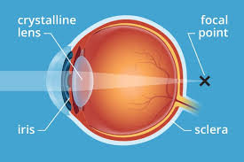 Presbyopia