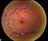 Retinal vein occlusion