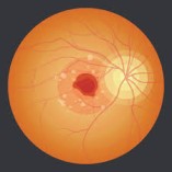 Macular edema