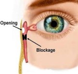 Dacryocystectomy eye