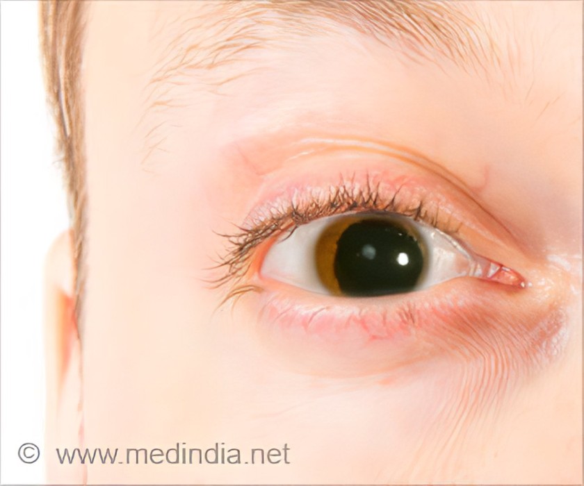 Aniridia Eye