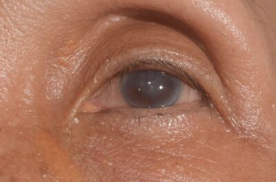 General Coverage for Cataract Surgery