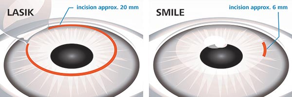 SMILE LASIK SURGERY COST IN BANGALORE