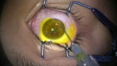 Lasik eye Surgery