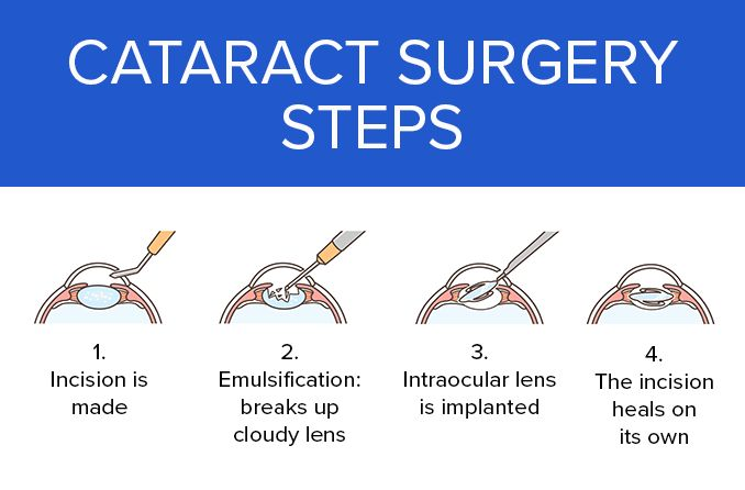 cataract operation types