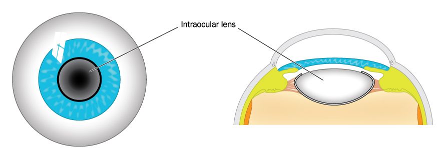 intraocular lens cost IN INDIA