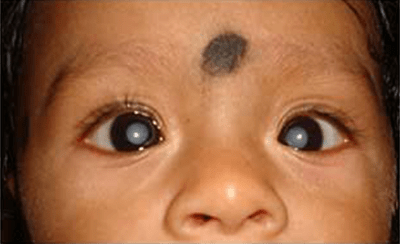 Congenital cataract eye treatment