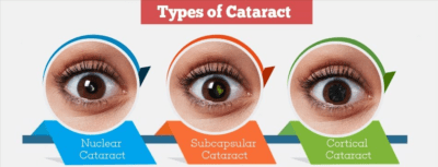 Kinds of cataract