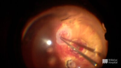 Retina transplat surgery