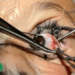 Squint surgery for blind eye