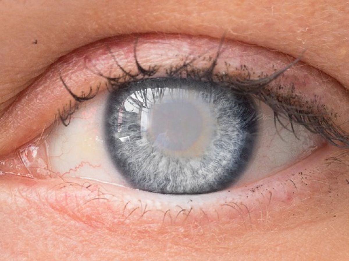 Cataract Surgery in Bangalore—Everything You Need to Know