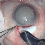 cataract surgery