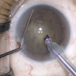 cataract surgery