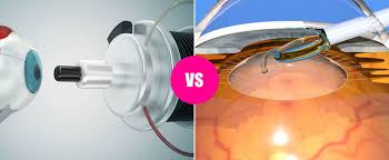 Lasik VS IOL Surgery