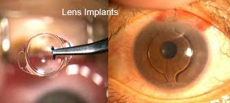 Eye lens Surgery