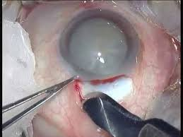 Cataract surgery

