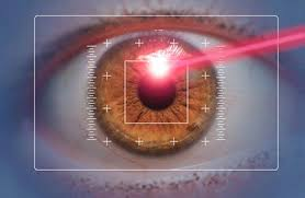 Laser Eye Correction Procedure