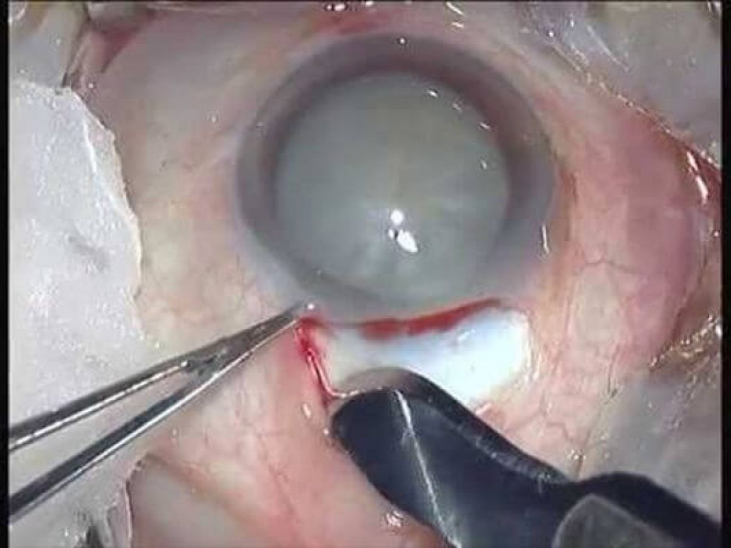 cataract operation procedure