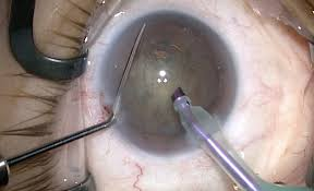 Laser eye Surgery for cataract