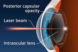 Posterior Capsular Opacification