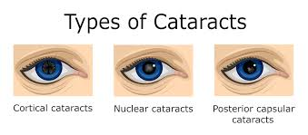 Type of cataract