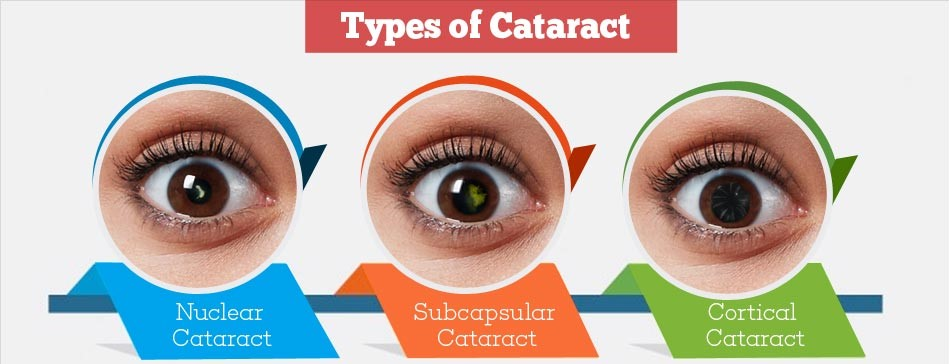 Kinds of Cataract