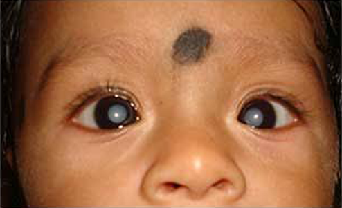 Congenital cataract