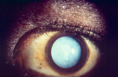 cataracts eyes