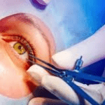 Laser eye surgery