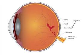 Pneumatic Retinopexy