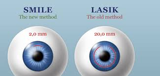 Lasik vs Smile  eye treatment
