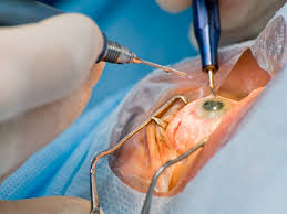 CVataract eye surgery