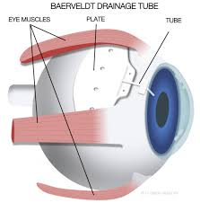 Glaucoma eye surgery