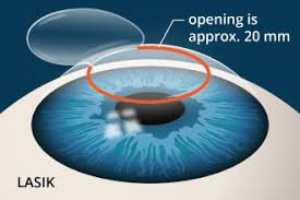 Lasik eye surgery procedure