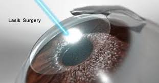 Lasik eye surgery