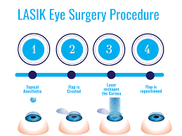 Lasik eye surgery procedure