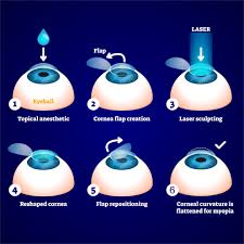 Lasik eye surgery procedure