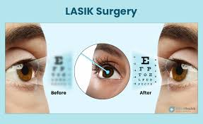 Lasik eye surgery result