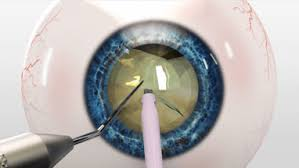 Cataract surgery