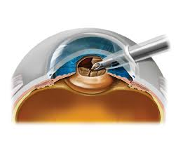 cataract surgery