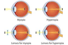 Hypermetropia different from Myopia