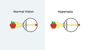 Causes of Hypermetropia