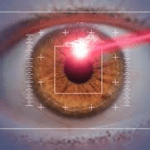 laser eye correction-new