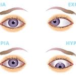 Type of squint eye