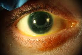 Aniridia eye