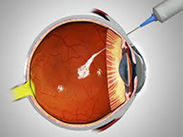 Intravitreal injection