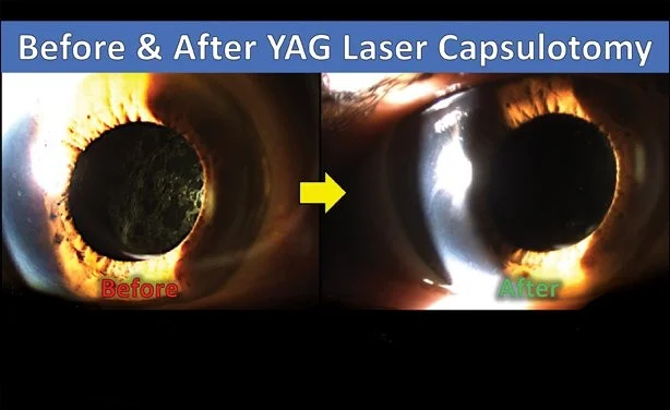 YAG Laser Eye Surgery