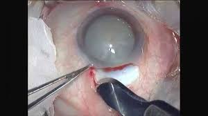 Cataract eye surgery